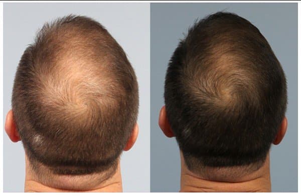PRP Hair rejuvenation