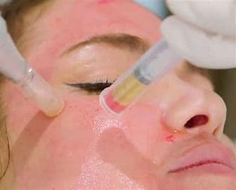 PRP Facial Microneedling